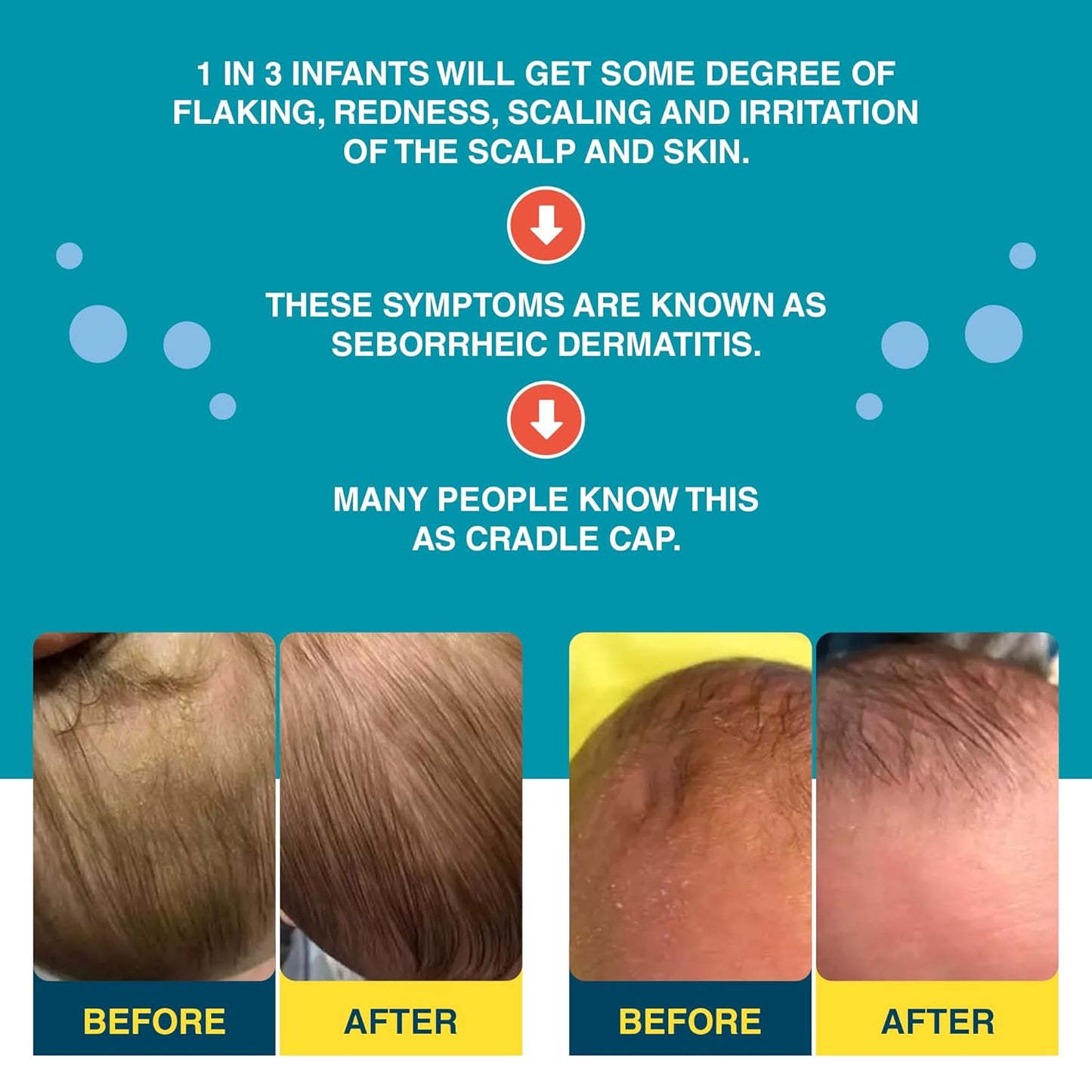 Happy Cappy Cradle Cap Medicated Shampoo and Body Wash with Beanie Brush - Baby Dandruff Shampoo, Helps Infants with Seborrheic Dermatitis, Dermatologist Tested, Fragrance-Free, Gentle Baby Scalp Scrubber - 2 Pieces