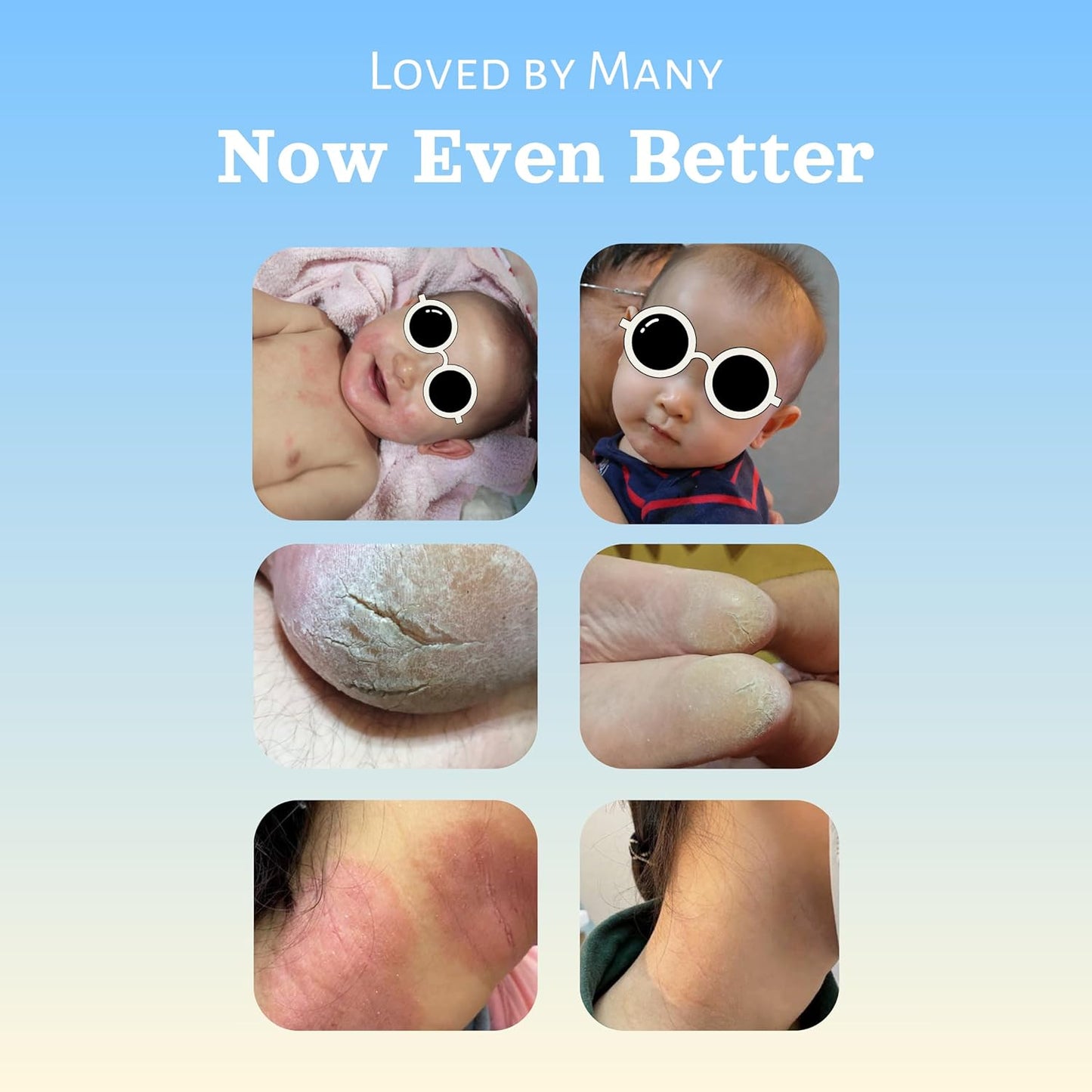 Natural SKIN REPAIR. Clinically tested Aromatherapy. Powerful Essential Oil. Eczema, Dermatitis, Diaper rash, and Sensitive skin. For all skin types. Hypoallergenic, Vegan, Paraben Free. 30ml BOTTLE