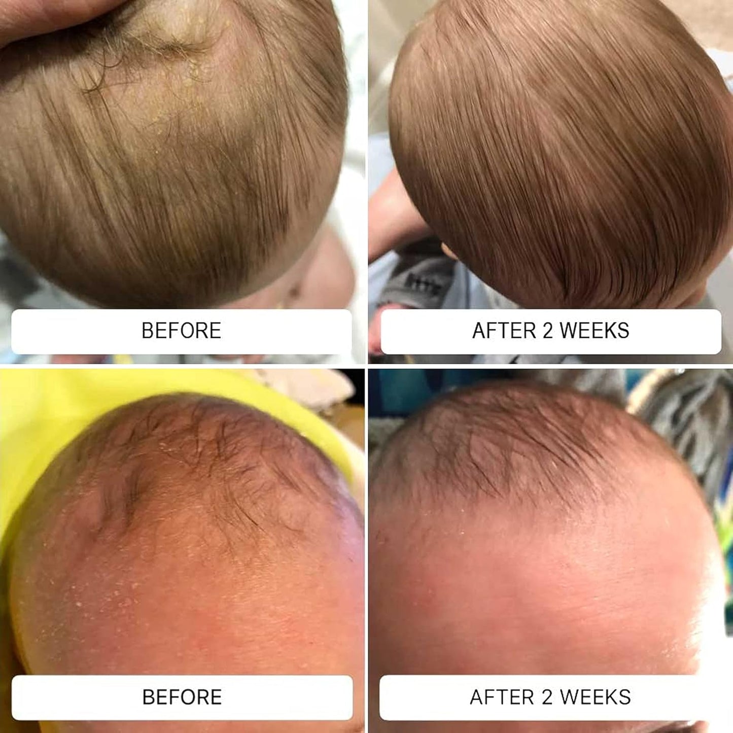 Happy Cappy Daily Medicated Shampoo and Body Wash Bundle - Baby Dandruff Shampoo, Helps Cradle Cap and Seborrheic Dermatitis, Reduces Redness, Dermatologist Tested, Fragrance-Free - 4 Pieces